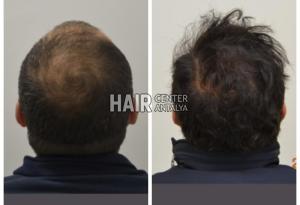 Antalya Hair Transplant Center Before & After