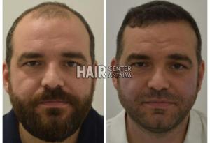 Antalya Hair Transplant Center Before & After